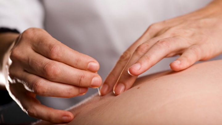 L’AGOPUNTURA, MEDICINA COMPLEMENTARE