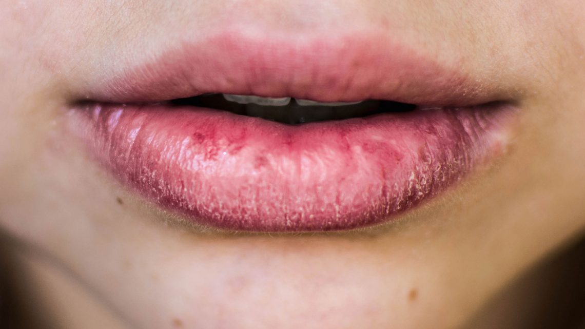 Labbra screpolate durante l’inverno? Ecco che cosa devi fare