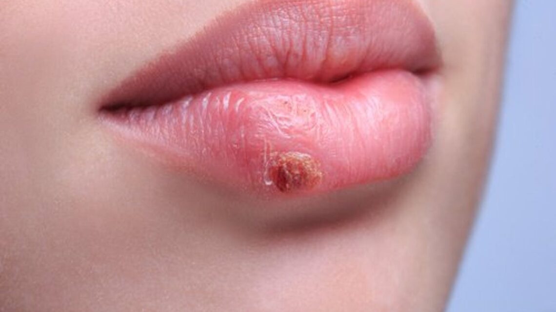 Come prevenire l’herpes labiale